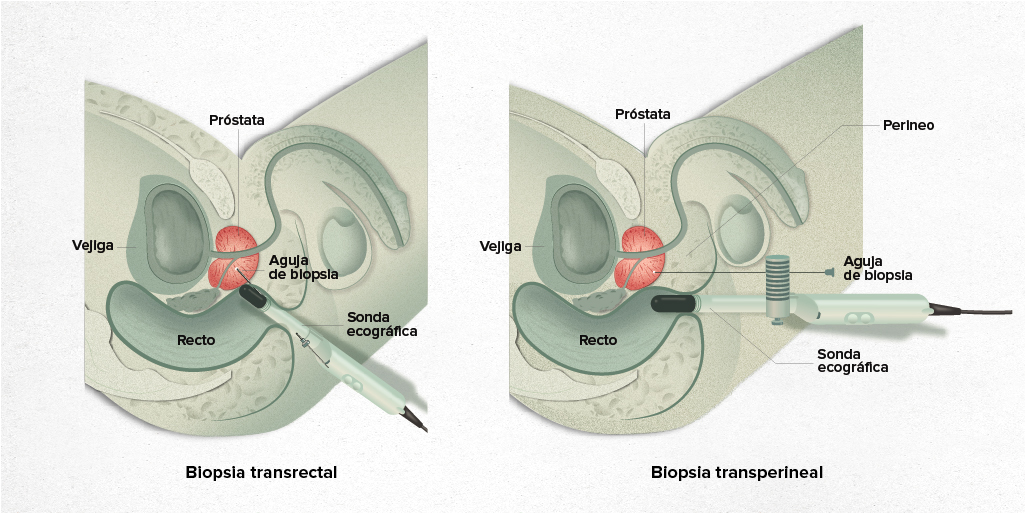 Biopsia prostática por fusión de imágenes